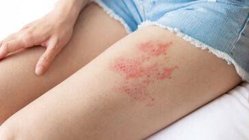 Mengenal Lebih Dekat Dengan Virus Herpes Dan Pencegahannya